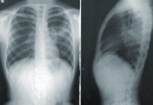 New lung cancer screening rollout to detect cancer sooner